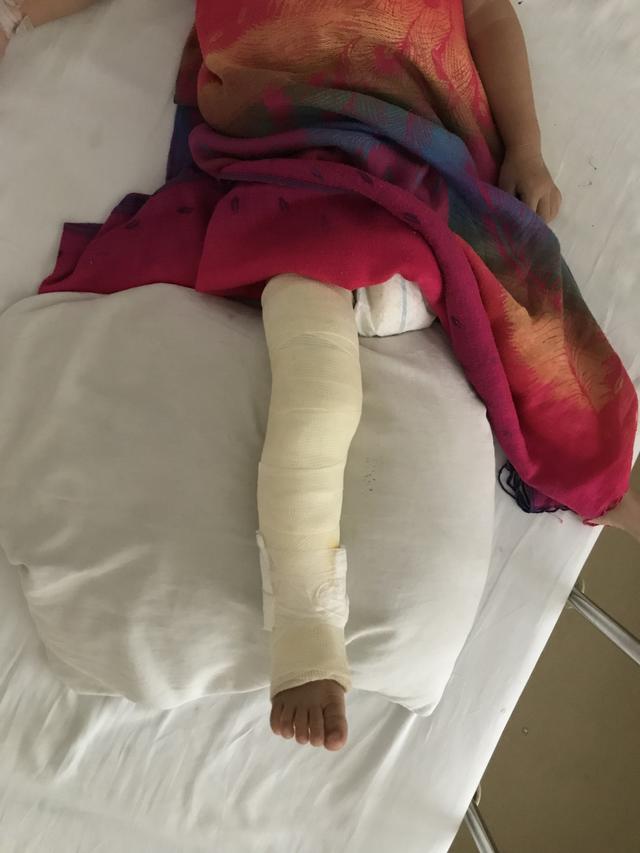 骨折后打了石膏，骨科医生必须交代患者的几件事