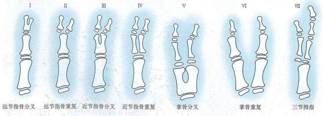 “六指神童”的六指是怎么来的？