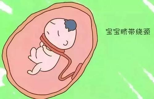 最怕宝宝在肚子里脐带绕颈，会不会勒住？胎儿脐带绕颈知识帮认知