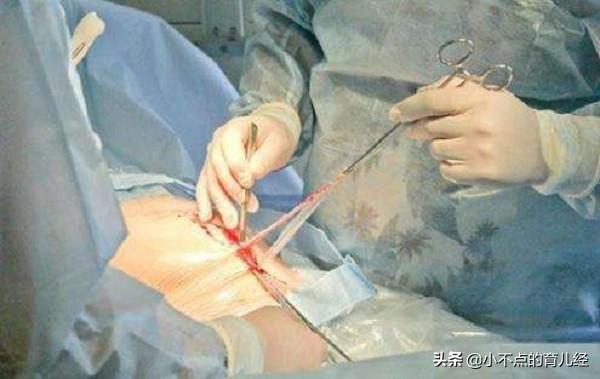 头胎剖腹产不疼，为何二胎剖腹产那么疼？产科大夫告诉你答案