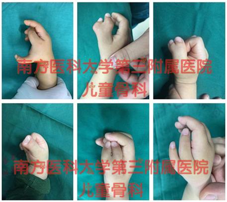 “六指神童”的六指是怎么来的？