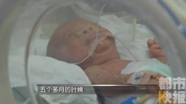 西安女子十年间流产5次后终于得子，孩子早产竟患有22种疾病