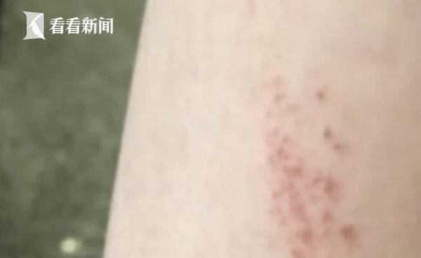 广州一幼儿园老师疑用火机烧孩子腿部，更令人气愤的是……