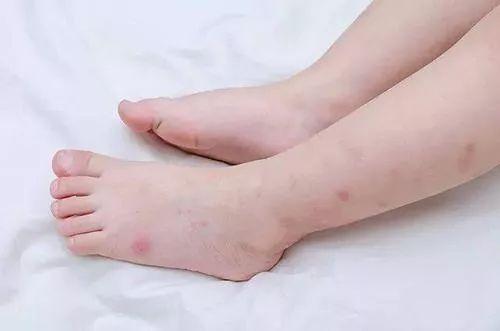 连做3次手术！4岁女童才保住一条命，就因为抠破一个“蚊子包”？