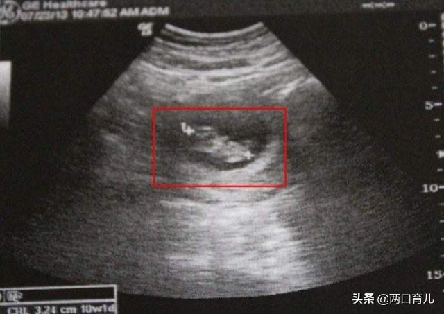 什么是脐带绕颈？胎儿发生脐带绕颈后，可以自己解脱吗？
