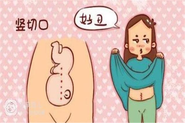 剖腹产时，“横切”和“竖切”该如何选择？女性心里要有数
