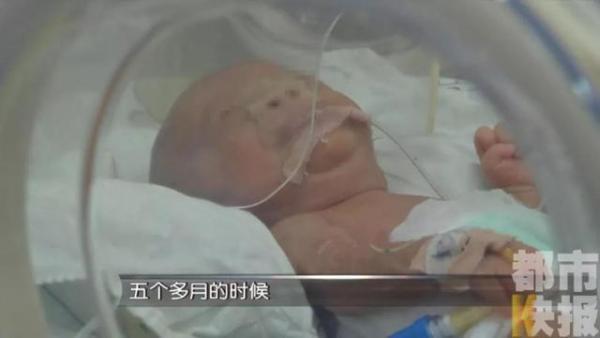 女子10年流产5次后终得子！保胎却遭早产，孩子还患22种疾病