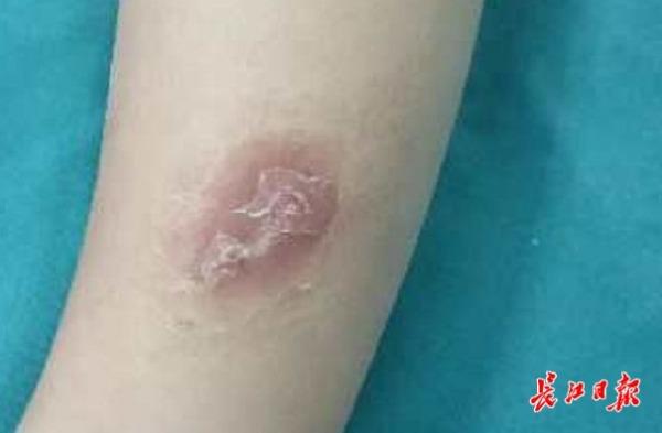 为什么宝宝的伤口总不见好？原来里面插着一根竹签
