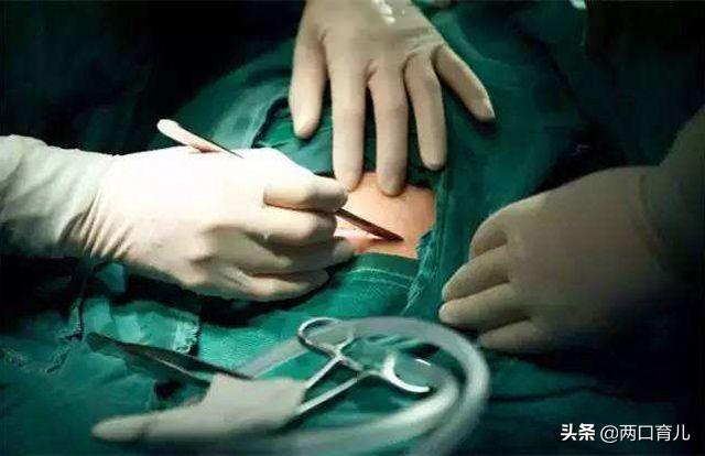 为什么剖腹产手术，大多数会选择在上午？3个好处孕妇要知道