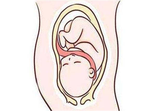 产检发现“脐带绕颈”，孕妈为胎儿想剖腹产，结果却被医生拒绝？