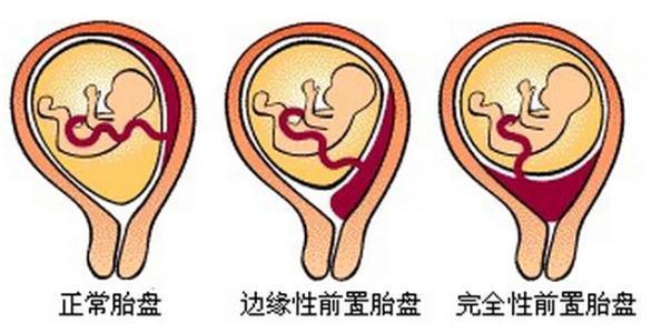 胎盘前置和胎盘低置有何不同？孕妈如何自我保健？
