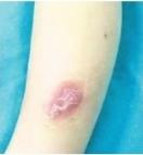 3岁男童腿伤半月未好 原是伤口里藏着竹签