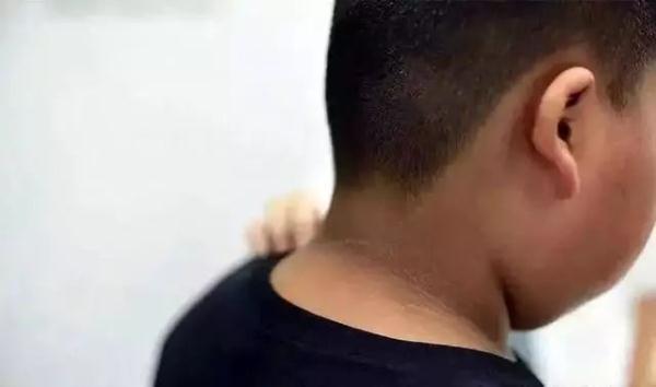 小孩脖子发黑洗不掉？别以为是小事，或许是病，赶紧看看吧