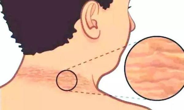 小孩脖子发黑洗不掉？别以为是小事，或许是病，赶紧看看吧