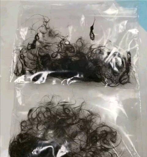 16小时“拉丝”手术，用坏6把异物钳！3岁女孩胃里取出两袋头发