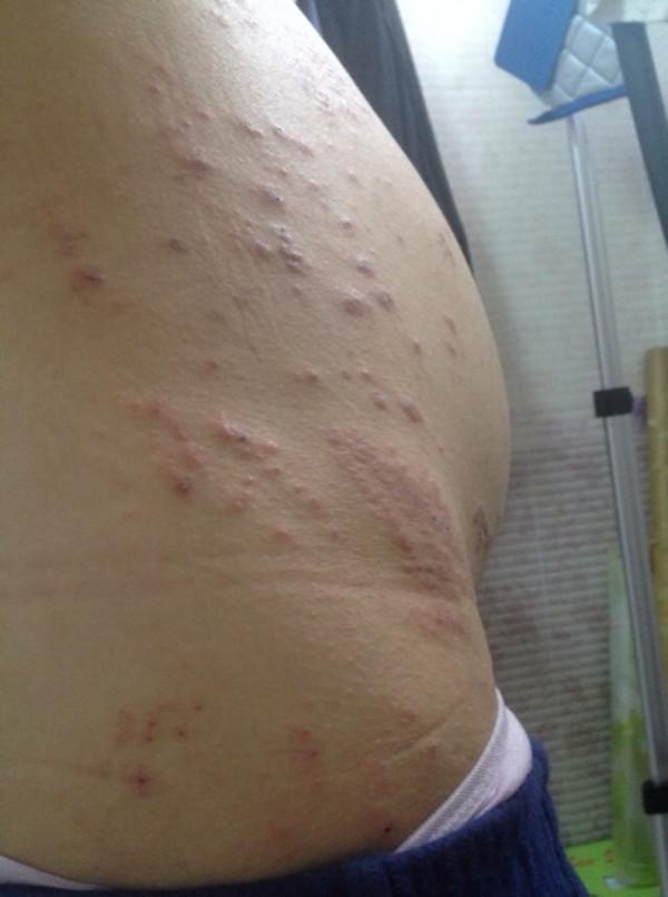 孕妈分泌“胎儿致命毒药”，孕期皮肤痒无小事，孕妈要重视