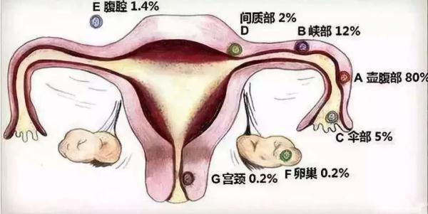 早孕妈妈需谨惕宫外孕