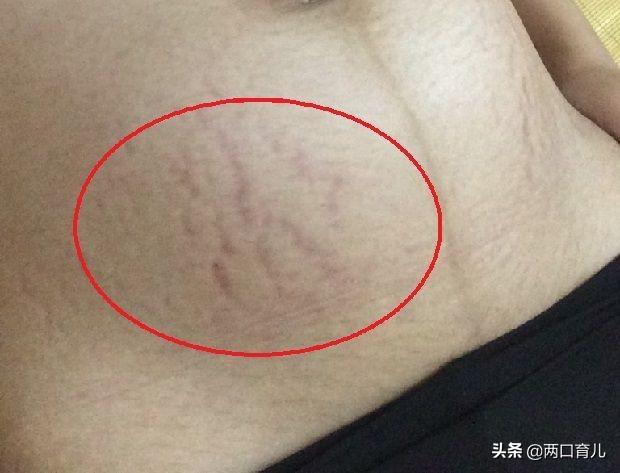 孕期是否会有妊娠纹，靠这3个因素决定，对比一下看看自己是不是