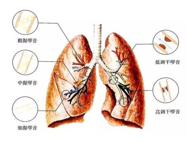 别把孩子肺炎当成感冒，这五种症状你要知道