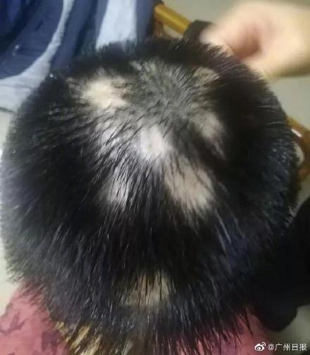 “秃”如其来，5岁娃因睡不好患斑秃总失眠熬夜的你也得小心了