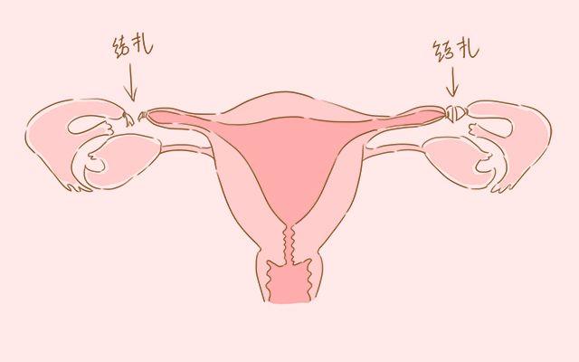 产后，女性是结扎好还是上环好？看看过来人的遭遇，你就明白了