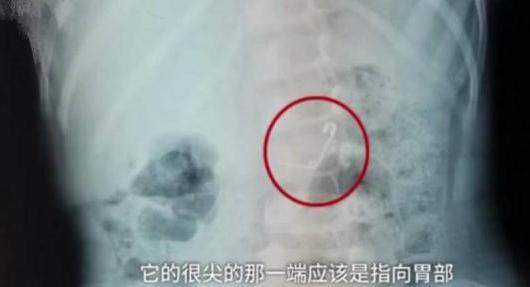3岁女童莫名肚子疼，医院检查后，网友心有余悸