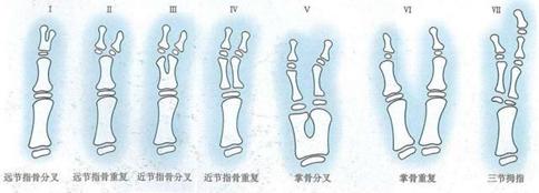 多指畸形的宝宝，可以恢复正常的小手吗？