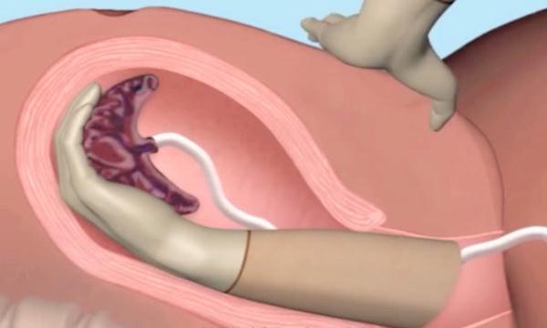 孕妇手剥胎盘有多痛，这几张3D图太真实，网友：隔着屏幕都疼