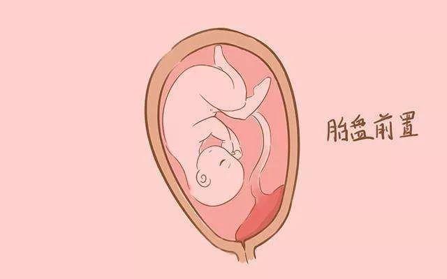 胎盘位置低，胎儿横在肚子里，怎么办呢？#清风计划#