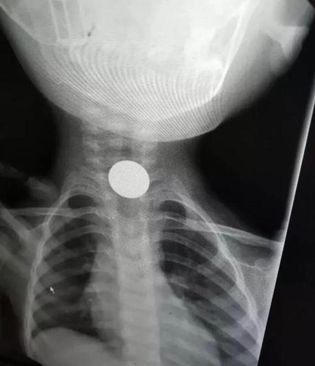 孩子误吞异物，掌握三要三不要原则，海姆立克急救法只是其中之一