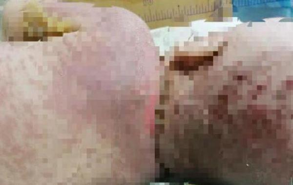 新生儿患感冒后，妈妈给喂了一包感冒药，不料宝宝竟全身溃烂