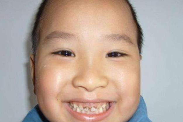 5岁男孩长7颗龋齿，医生直言：并不是吃糖吃的，而是和习惯有关