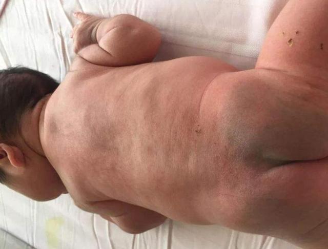 新生儿身上,为什么会有大片的青斑,对宝宝健康有影响吗?