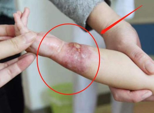 孩子烫伤后，最佳治疗时间只有120秒，你知道怎么做？这里告诉你