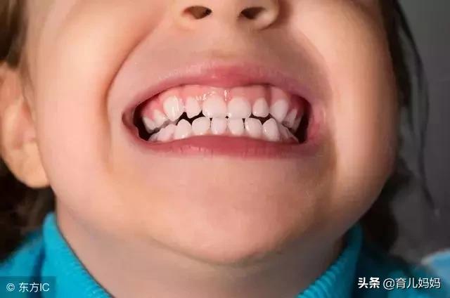 孩子乳牙滞留造成双排牙，都是家长惯的，别再害你家宝宝了