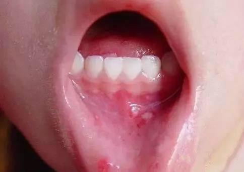 有“这种病”的人别强行亲吻宝宝！后果你承担不起……