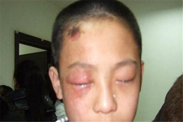 3岁宝宝把石灰弄进眼睛，妈妈不敢用水冲，致使娃眼睛灼伤严重