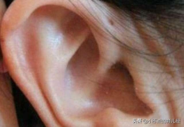 儿科医生：这种小孔并非有福气，如果是这3种情况，需及时就医