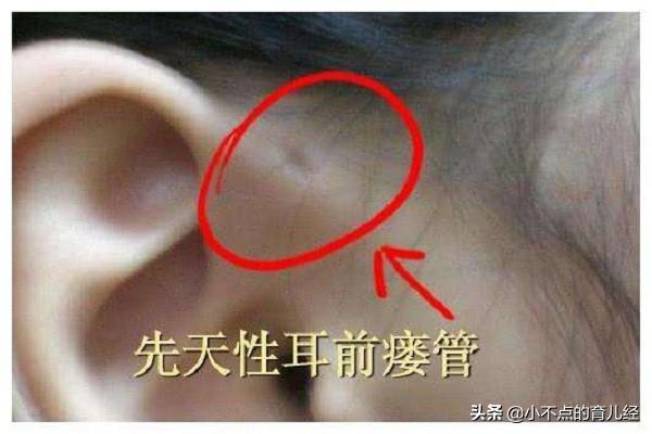 儿科医生：这种小孔并非有福气，如果是这3种情况，需及时就医