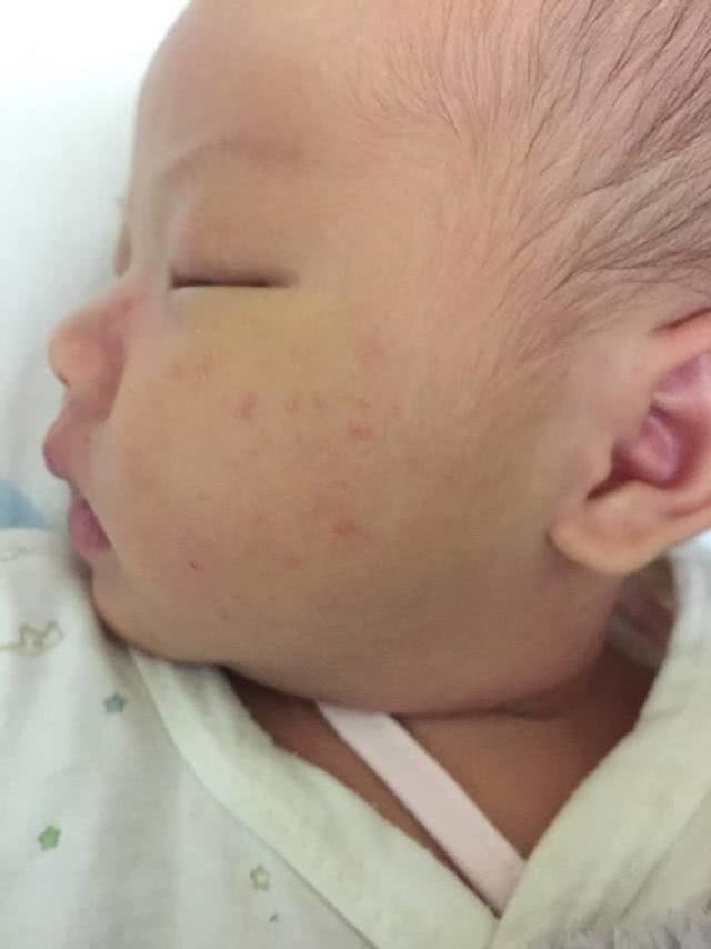 宝宝长了奶藓还以为是痱子？这两者完全不同，宝妈们要注意了