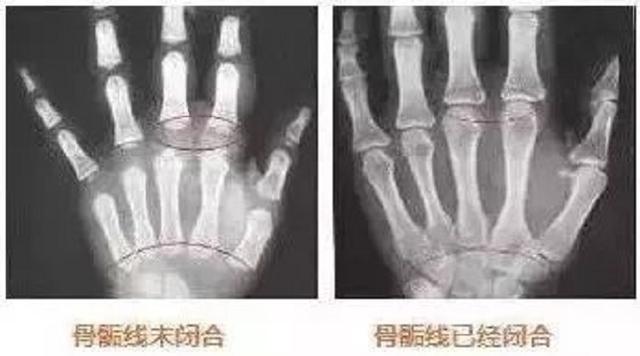 育儿｜孩子身上这条线，决定最终身高！多长10cm就靠它了