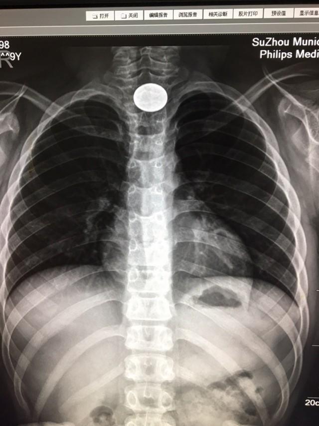 碰到异物卡喉该怎么办？医护人员教你“海姆立克急救法”