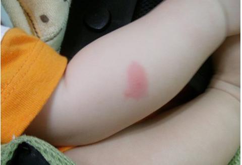 男童被蚊虫叮咬,奶奶用"土方法"消毒致感染,不少家长都这样