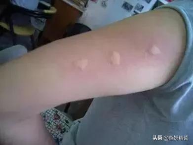 6岁孩子被蚊子叮咬后昏迷不醒，这些事，家长一定要知道