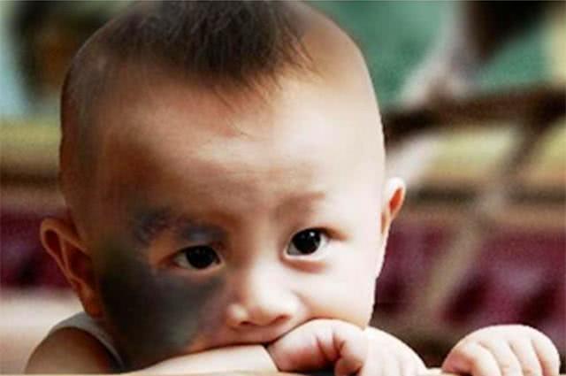 宝宝身上的“胎记”，大多是在孕期埋下的“根”，孕妈要注意避免