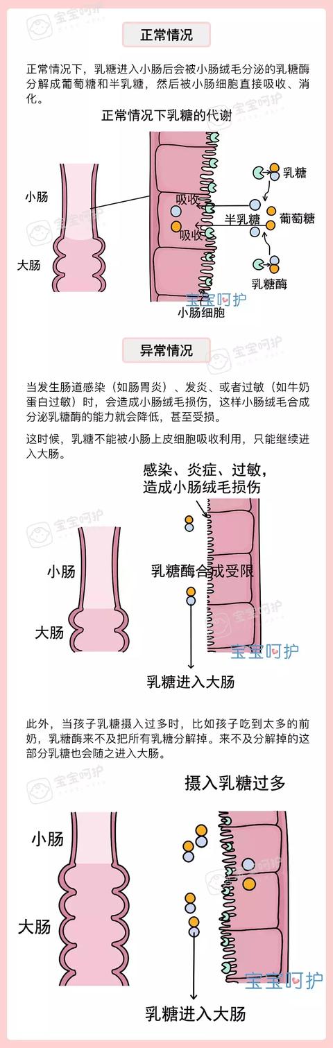 孩子腹泻老好不了，多半是这个病因在搞鬼！很多医生都会漏诊