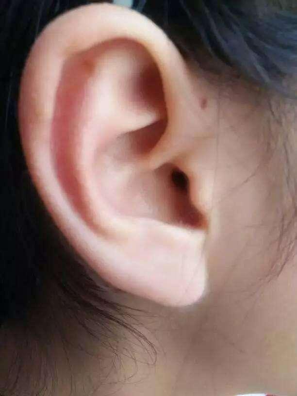 胎儿出生后，耳朵上出现&quot;小孔&quot;是咋回事？不懂的父母不妨了解下