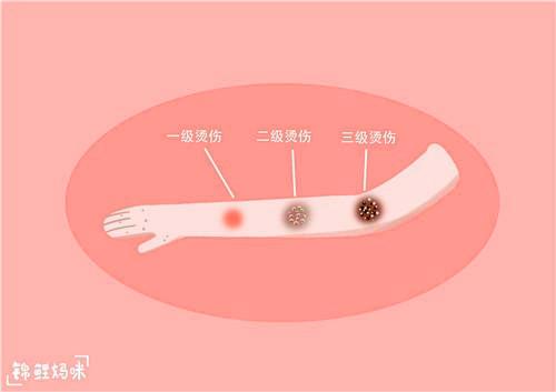 孩子被开水烫伤，妈妈的做法让全家人都反对，医生却竖起了大拇指