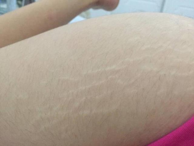 怀孕后，孕妈肚皮会有这5点变化，最后一个准妈妈要多注意