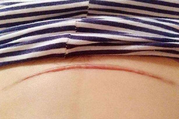 剖腹产横切竖切区什么区别？二胎妈妈：差别可不小，第一胎别选错